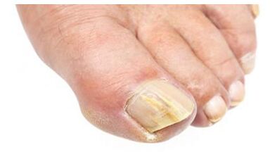 Fungal diseases of the feet and nails