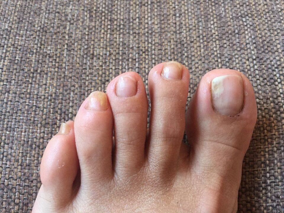 Causes of toenail fungus